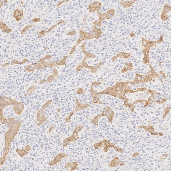 IHC staining of human stomach cancer using 66096-1-Ig IHC staining of human stomach cancer using 66096-1-Ig