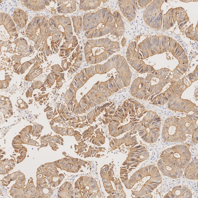 IHC staining of human colorectal cancer using 66096-1-Ig IHC staining of human colorectal cancer using 66096-1-Ig