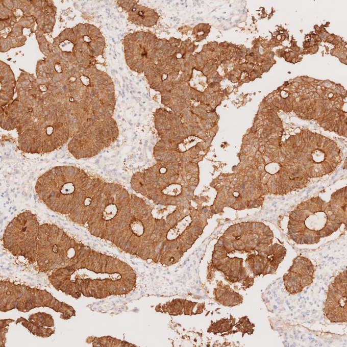 IHC staining of human colorectal cancer using 66096-1-Ig IHC staining of human colorectal cancer using 66096-1-Ig