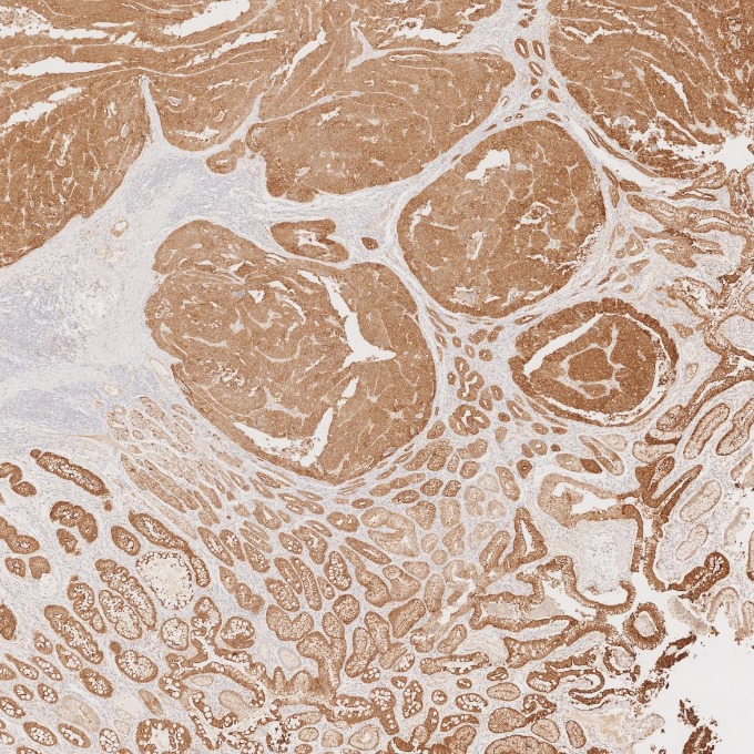 IHC staining of human stomach cancer using 66096-1-Ig IHC staining of human stomach cancer using 66096-1-Ig