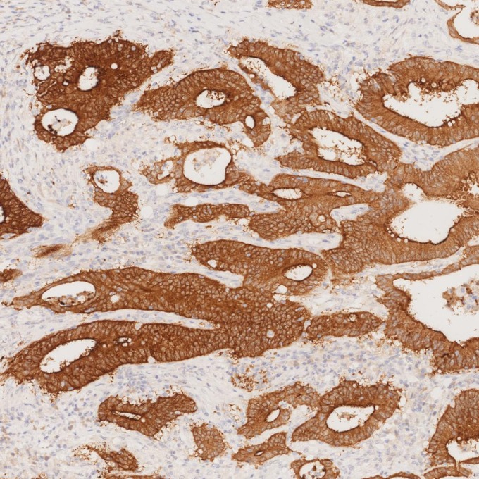 IHC staining of human colorectal cancer using 66096-1-Ig IHC staining of human colorectal cancer using 66096-1-Ig