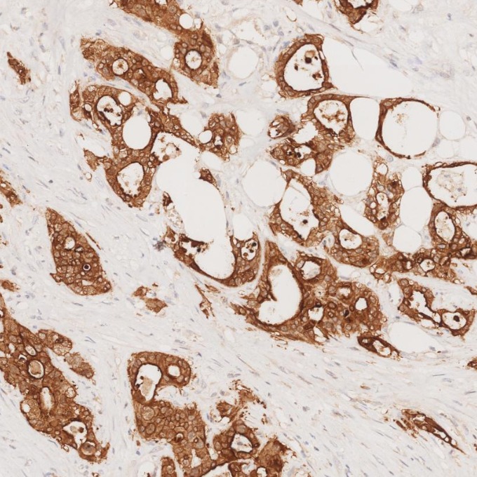 IHC staining of human pancreas cancer using 66096-1-Ig IHC staining of human pancreas cancer using 66096-1-Ig