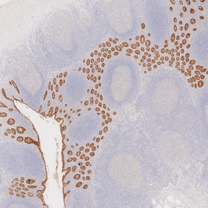 IHC staining of human appendicitis using 66096-1-Ig IHC staining of human appendicitis using 66096-1-Ig