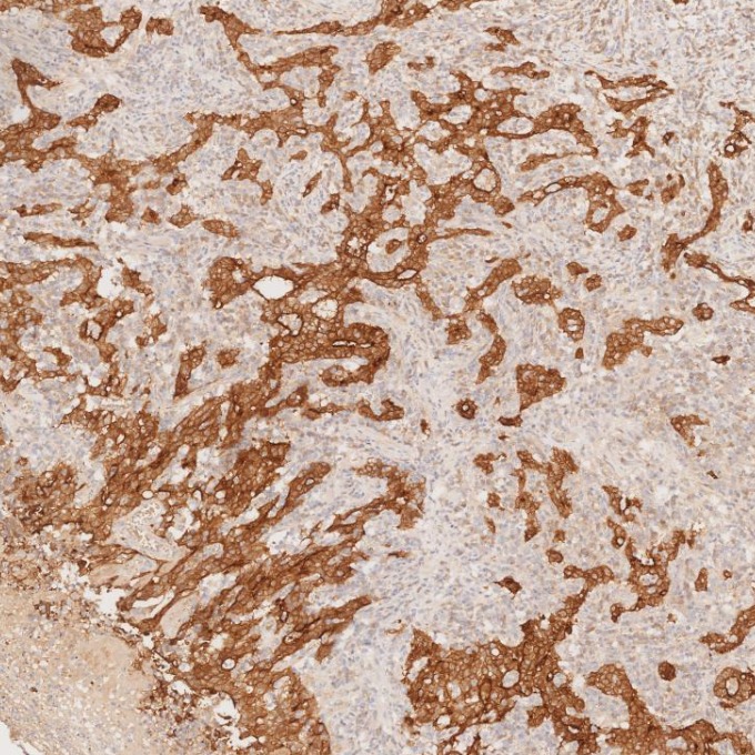 IHC staining of human stomach cancer using 66096-1-Ig IHC staining of human stomach cancer using 66096-1-Ig