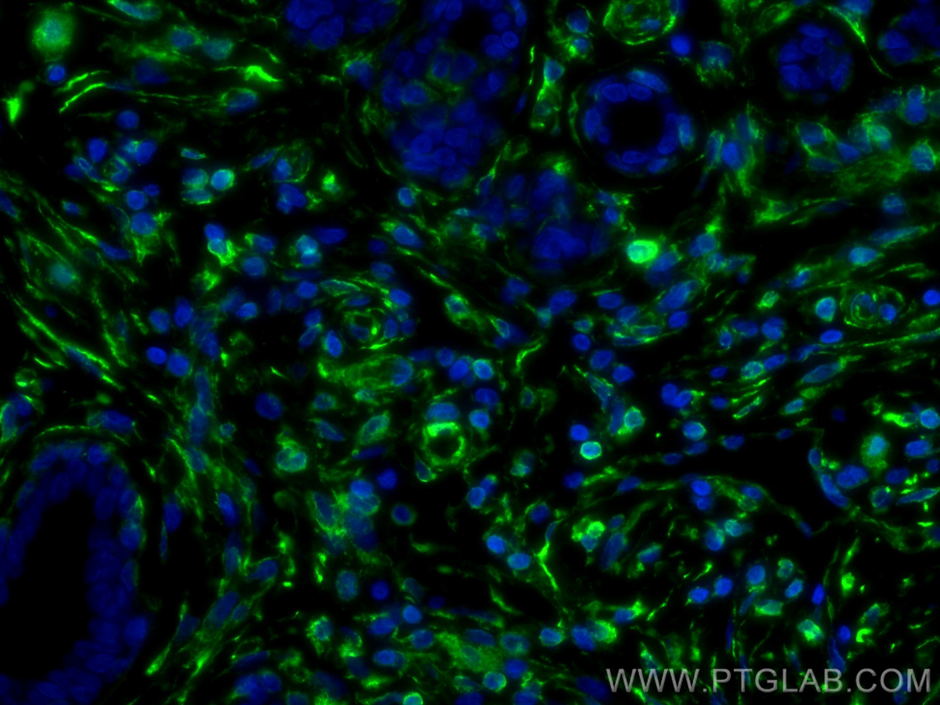 IF Staining of human breast cancer using 10366-1-AP