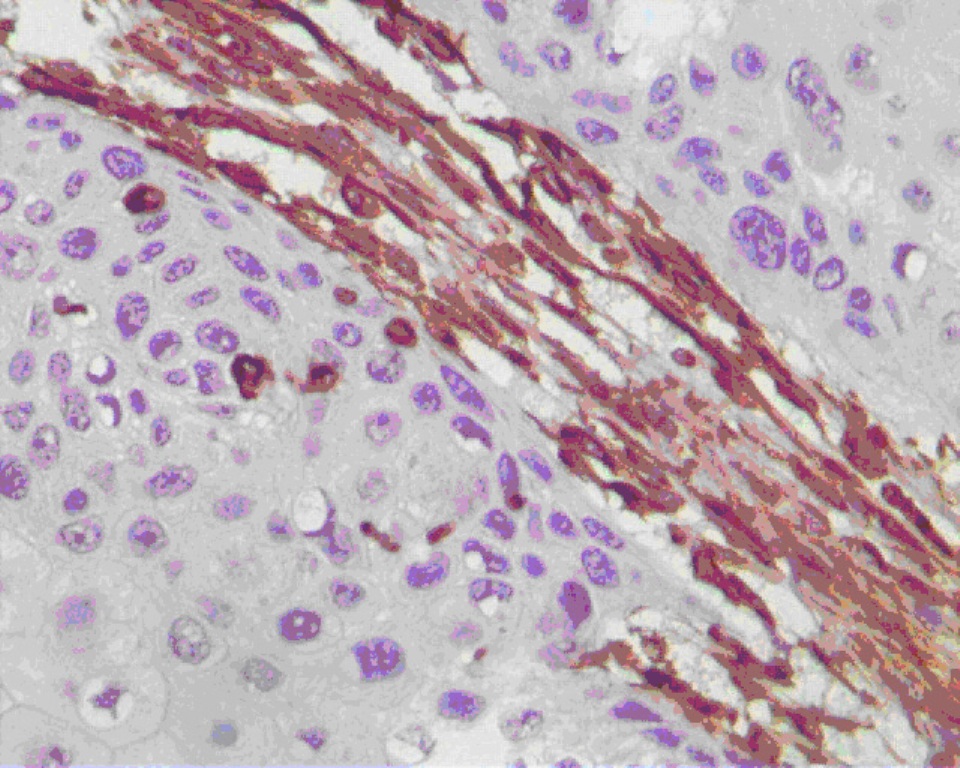 IHC staining of human lung cancer using 65039-1-Ig