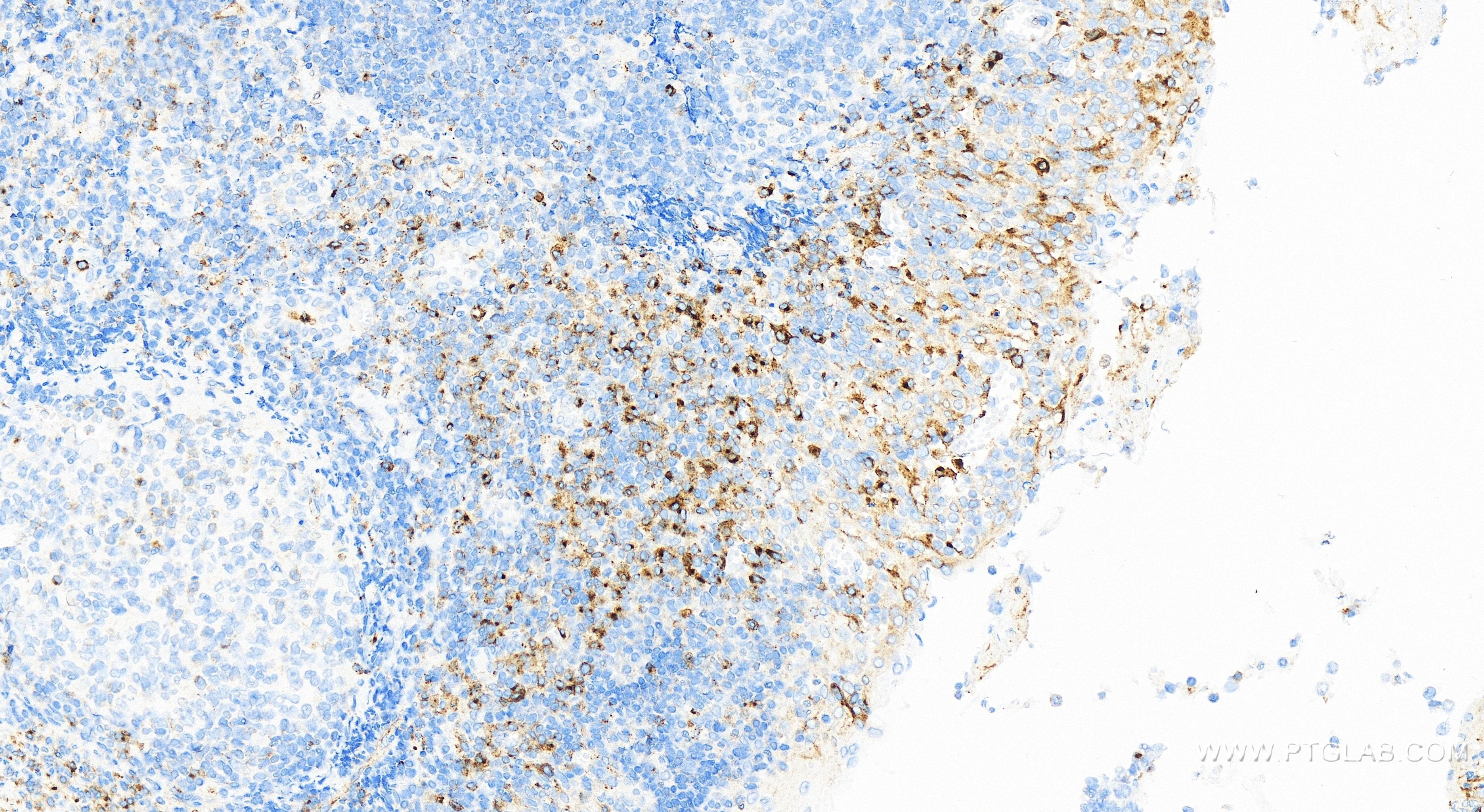 IHC staining of human tonsillitis using 83919-4-RR (same clone as 83919-4-PBS)