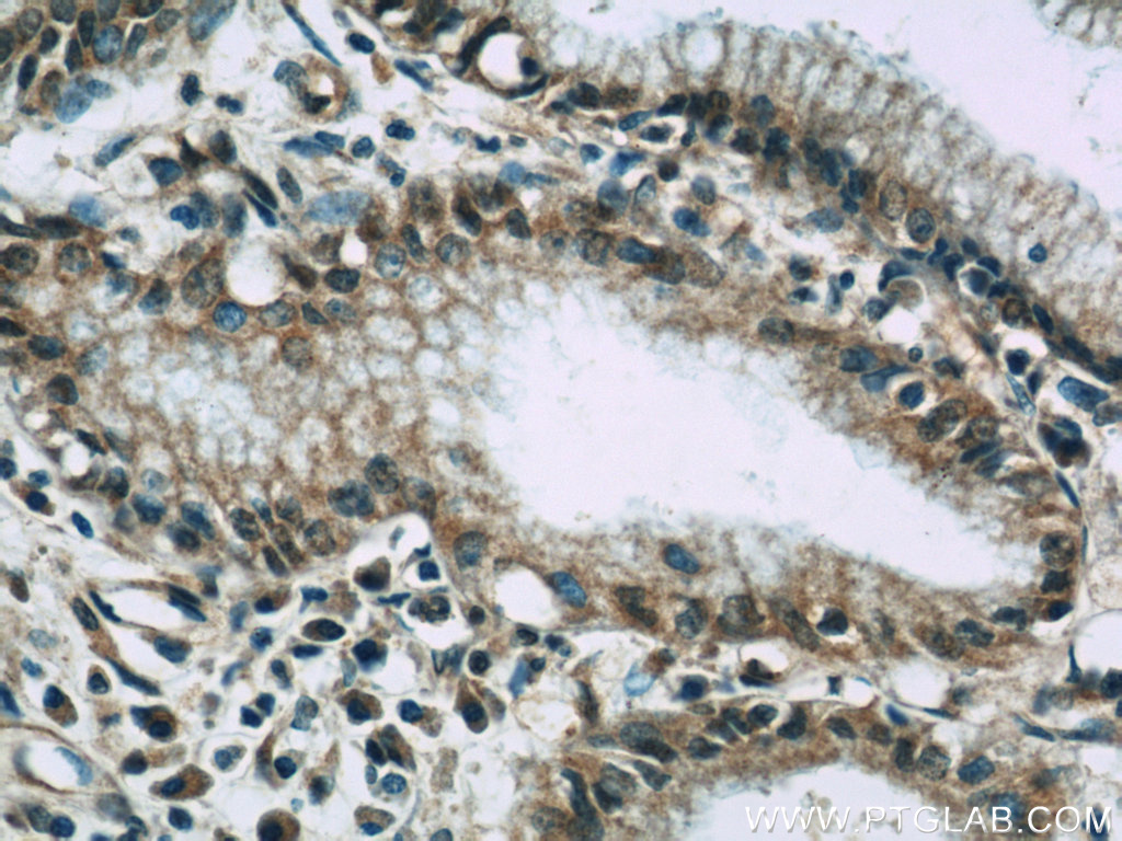 IHC staining of human pancreas cancer using 21745-1-AP