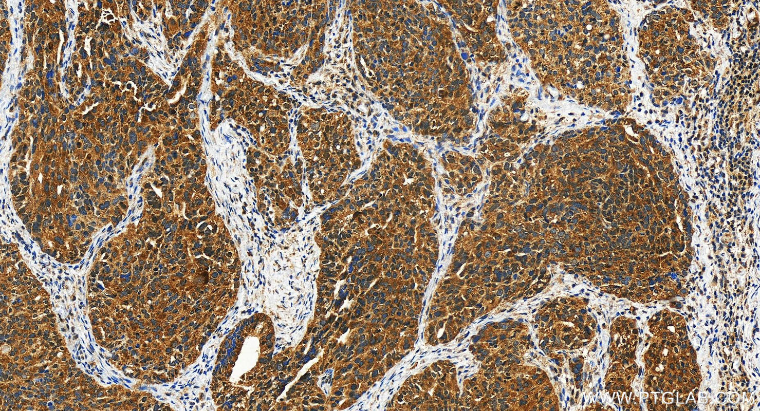 IHC staining of human ovary cancer using 29387-1-AP