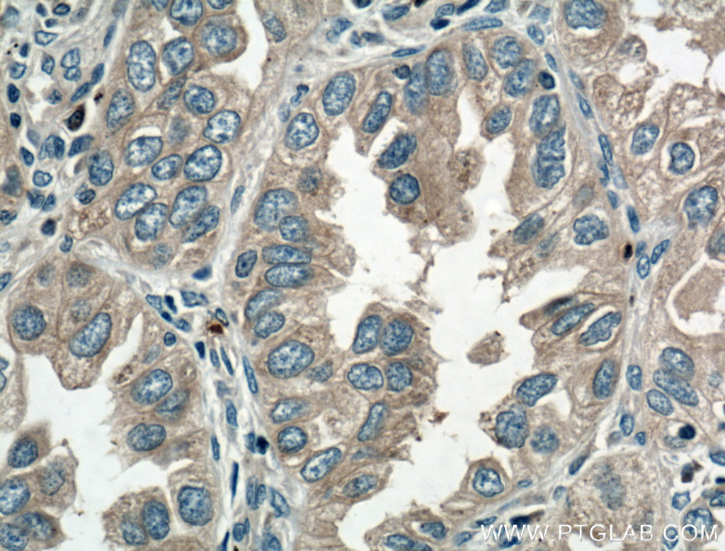IHC staining of human lung cancer using 10901-1-AP