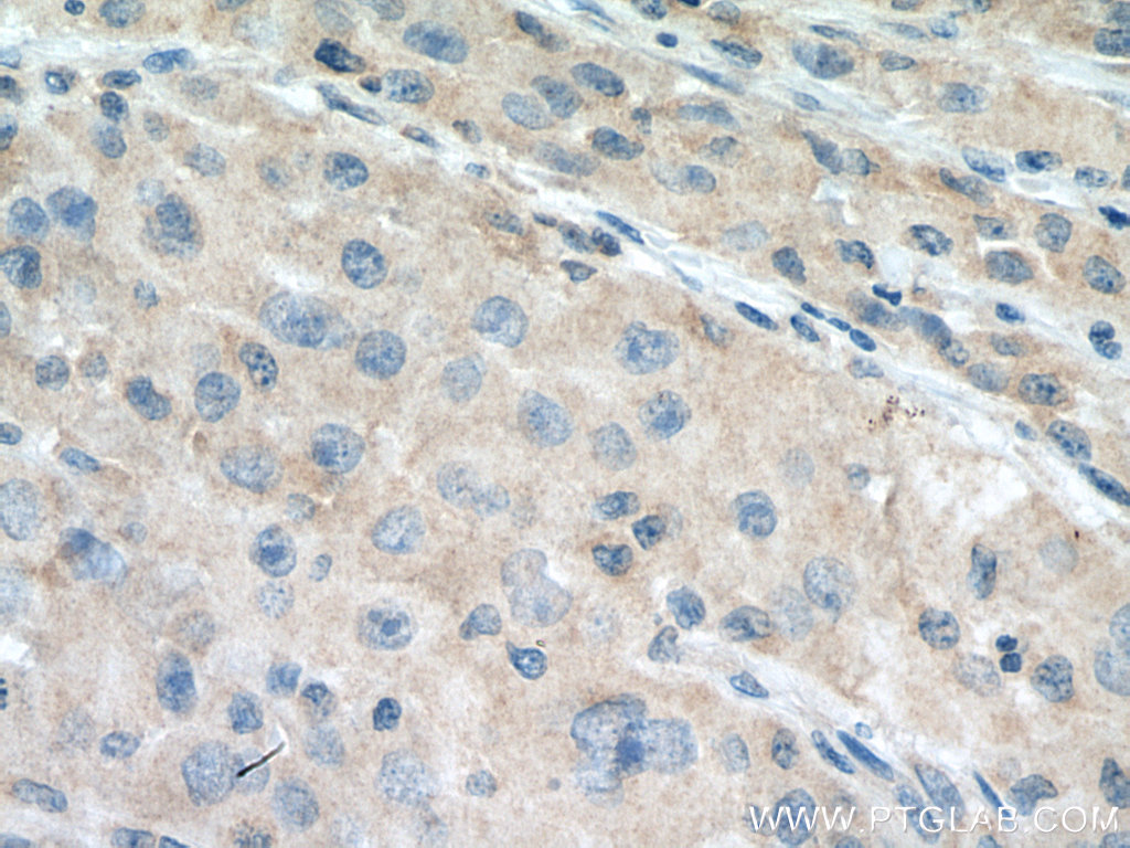 IHC staining of human liver cancer using 67590-1-Ig (same clone as 67590-1-PBS)