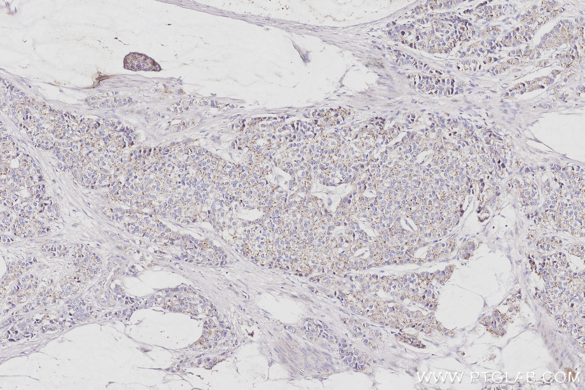 IHC staining of human stomach cancer using 15472-1-AP IHC staining of human stomach cancer using 15472-1-AP