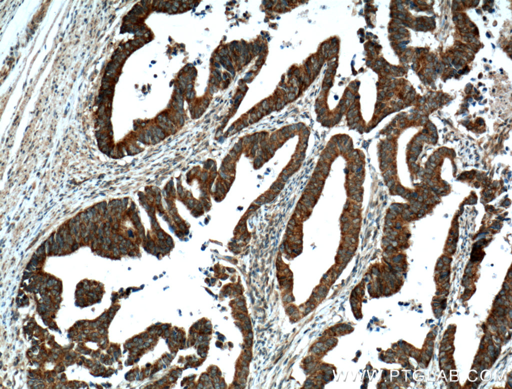 IHC staining of human colon cancer using 12195-1-AP