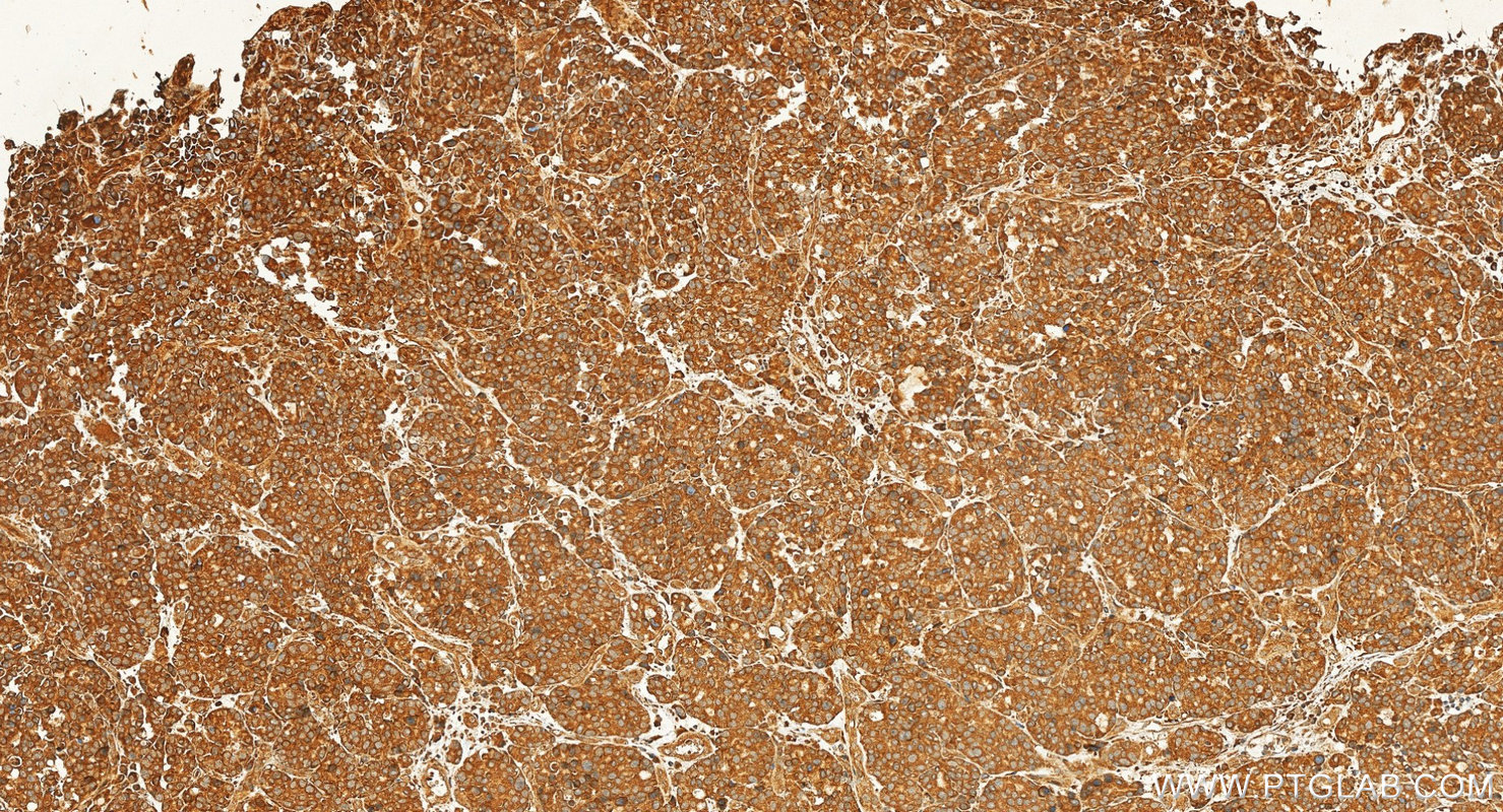 IHC staining of human stomach cancer using 87952-1-RR