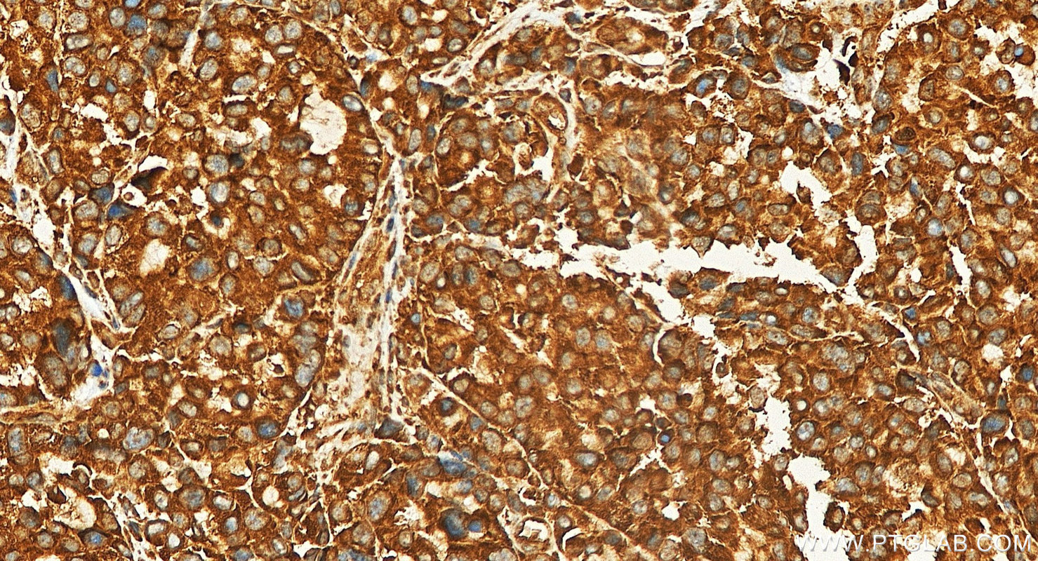 IHC staining of human stomach cancer using 87952-1-RR