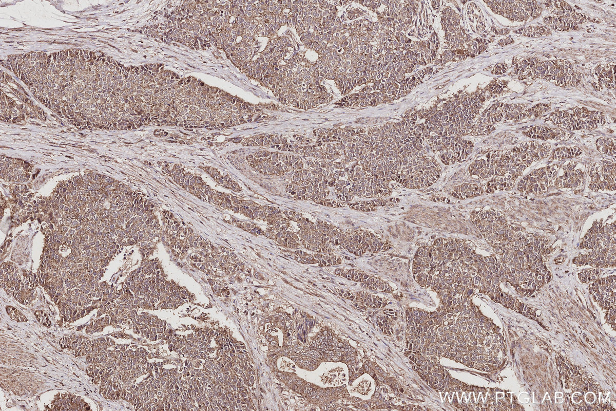 IHC staining of human stomach cancer using 14272-1-AP IHC staining of human stomach cancer using 14272-1-AP