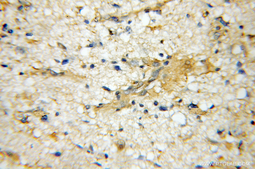 IHC staining of human gliomas using 11662-2-AP