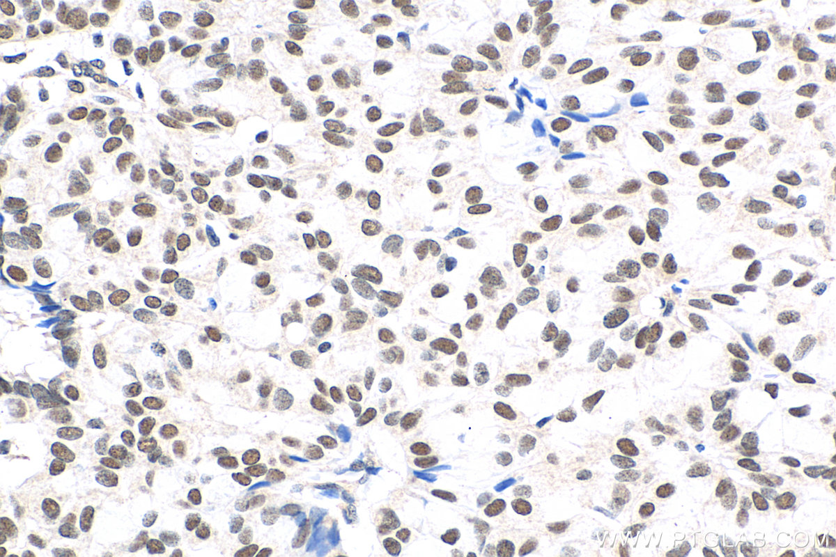 IHC staining of human breast hyperplasia using 15143-1-AP