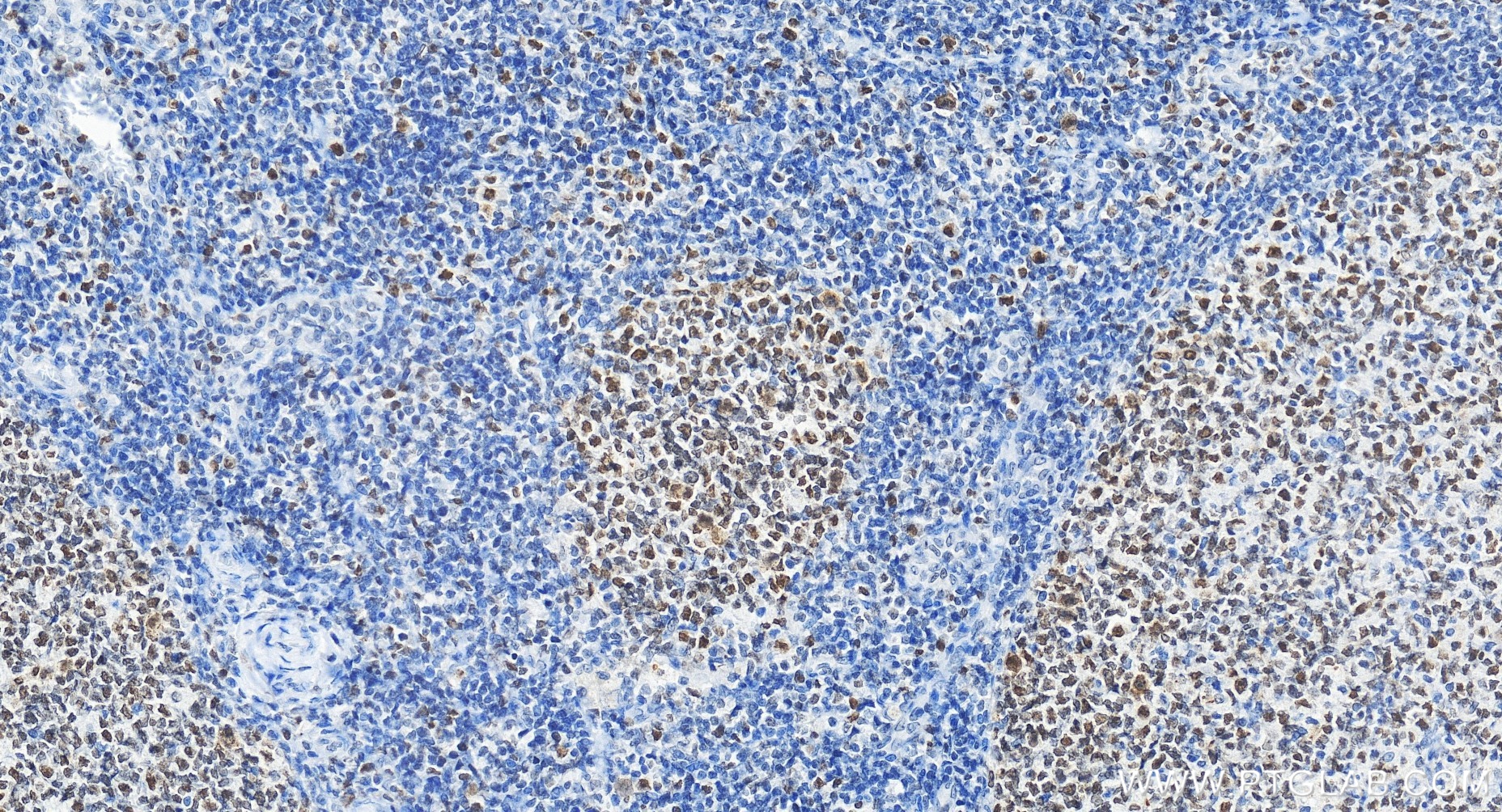 Immunohistochemical analysis of paraffin-embedded human tonsillitis tissue slide using 85598-2-RR (VRK1 antibody) at dilution of 1:800 (under 20x lens). Heat mediated antigen retrieval with Tris-EDTA buffer (pH 9.0). IHC staining of human tonsillitis using 85598-2-RR