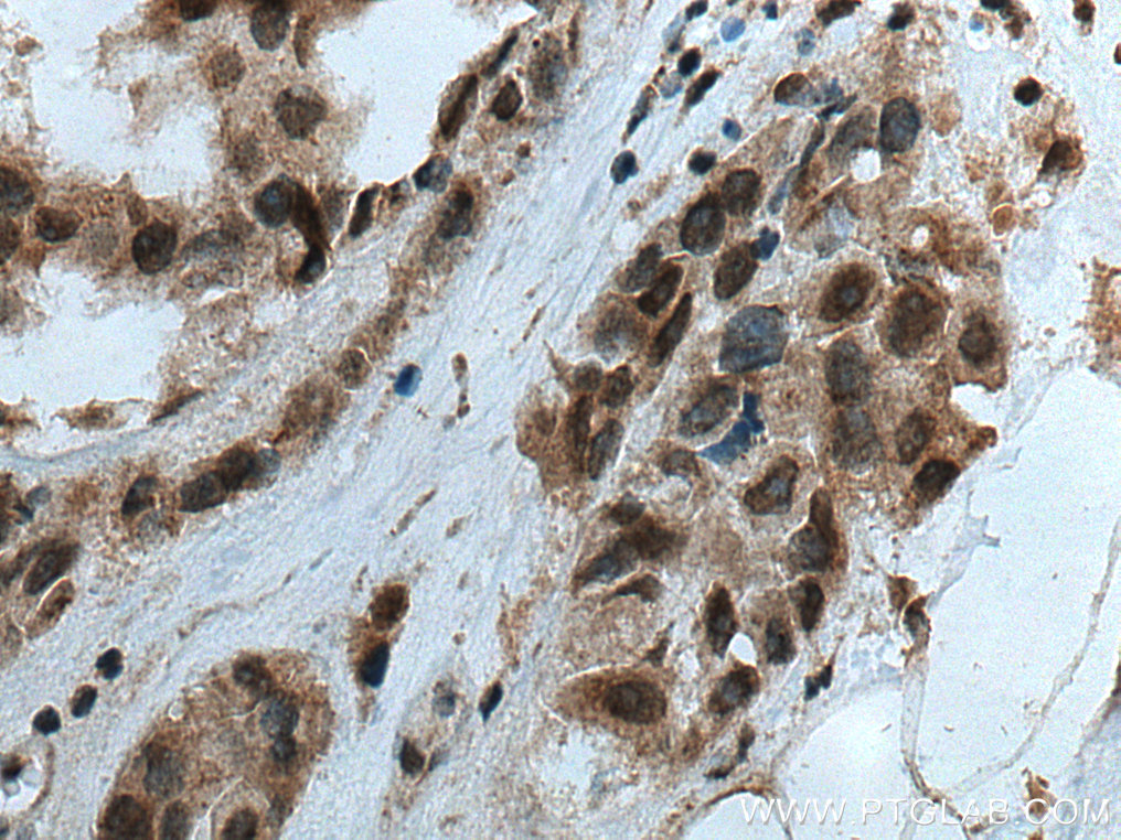 IHC staining of human breast cancer using 15608-1-AP (same clone as 15608-1-PBS)
