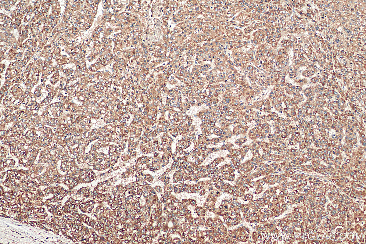 IHC staining of human liver cancer using 14495-1-AP