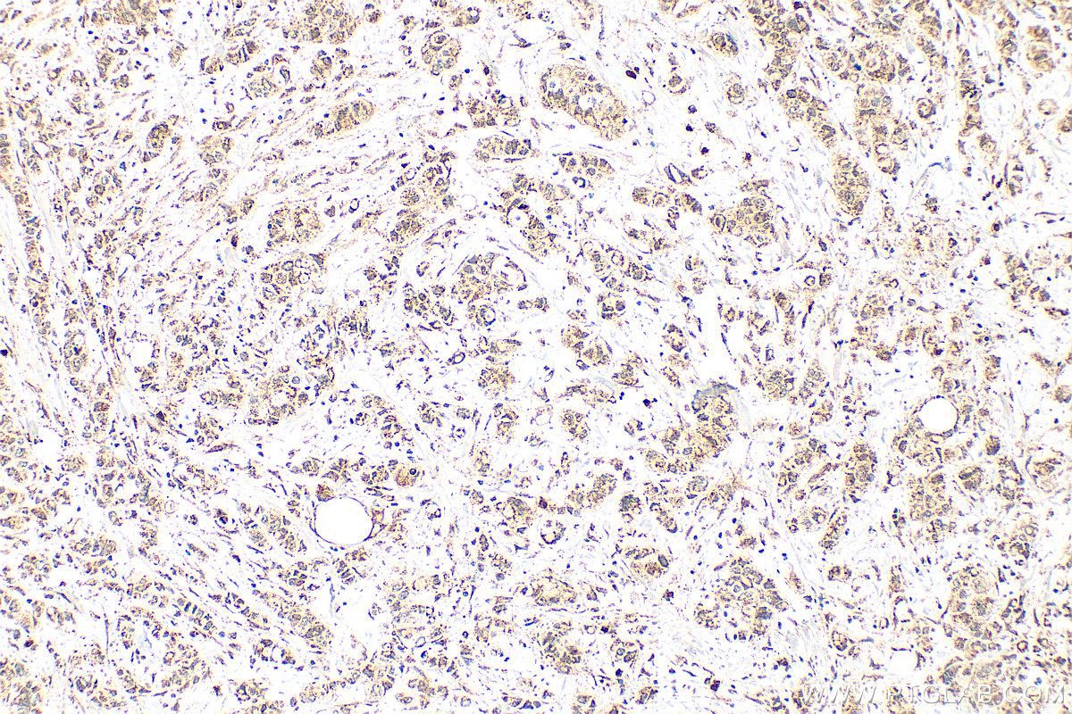 IHC staining of human breast cancer using 26175-1-AP