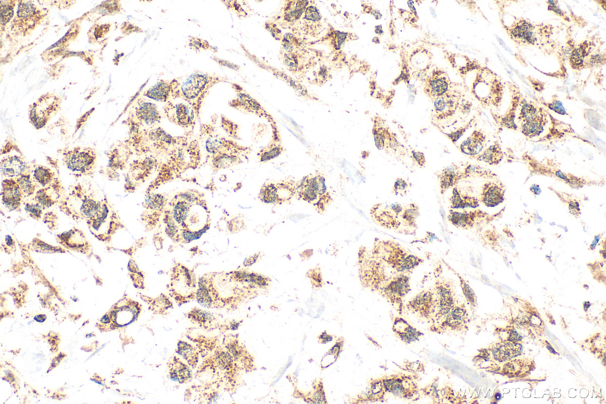 IHC staining of human breast cancer using 26175-1-AP