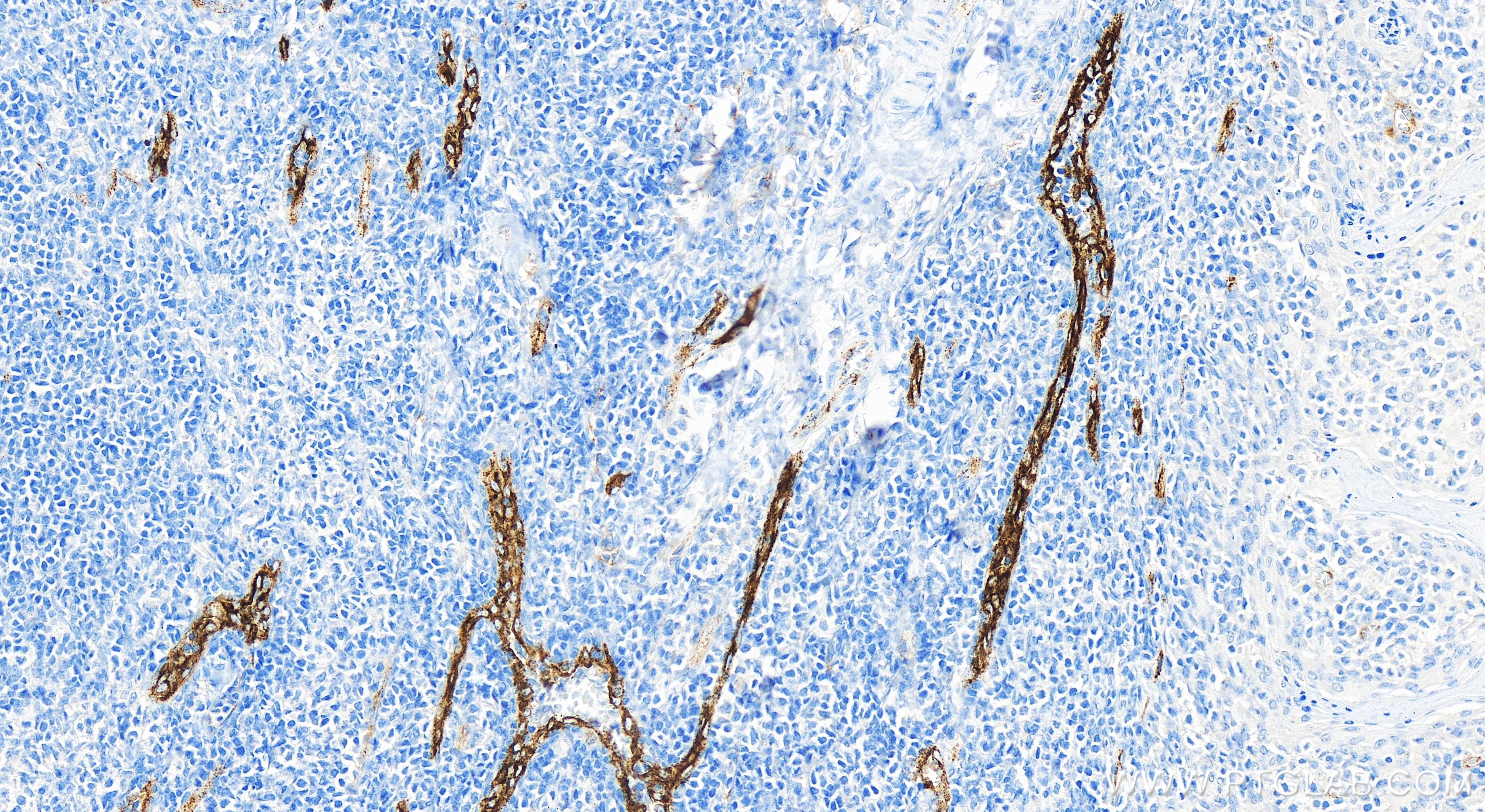 IHC staining of human tonsillitis using 83854-2-RR
