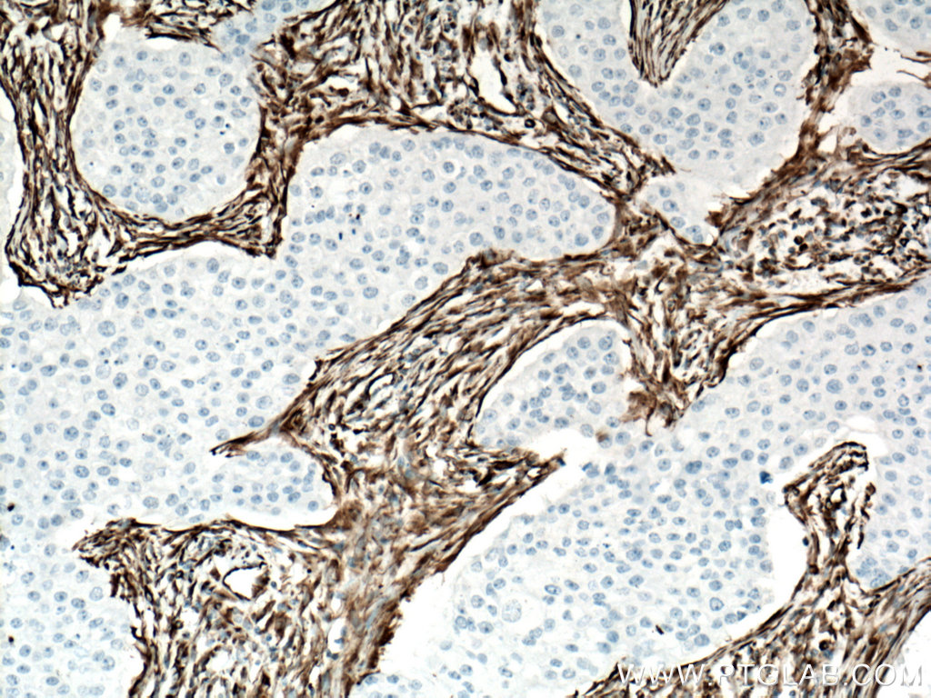 IHC staining of human breast cancer using 60330-1-Ig (same clone as 60330-1-PBS)