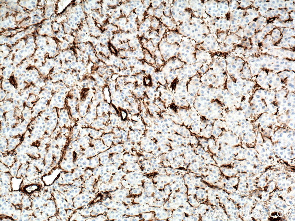 IHC staining of human liver cancer using 60330-1-Ig (same clone as 60330-1-PBS)