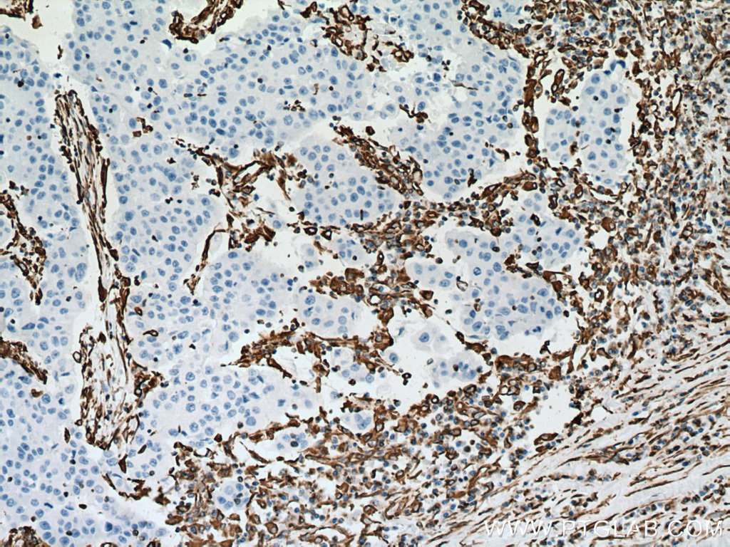 IHC staining of human breast cancer using 60330-1-Ig (same clone as 60330-1-PBS)