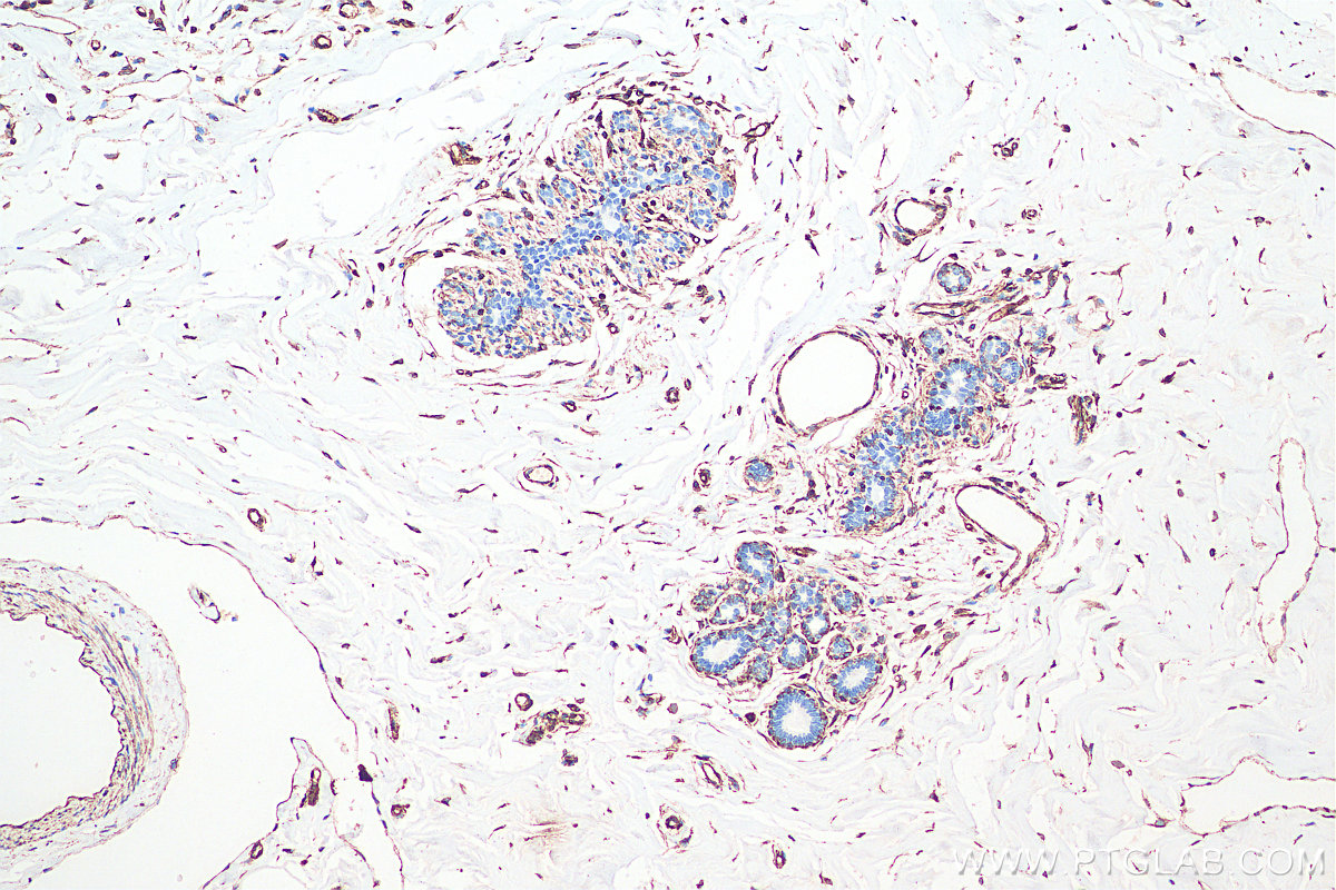 IHC staining of human breast cancer using 60330-1-Ig IHC staining of human breast cancer using 60330-1-Ig