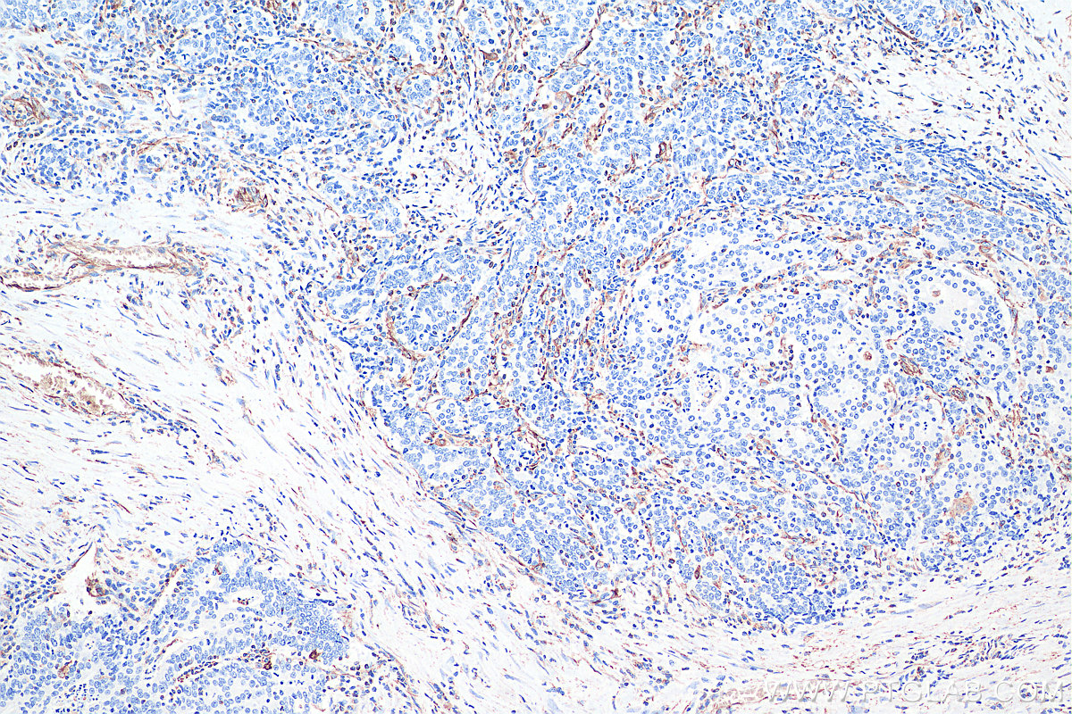 IHC staining of human colon cancer using 60330-1-Ig IHC staining of human colon cancer using 60330-1-Ig