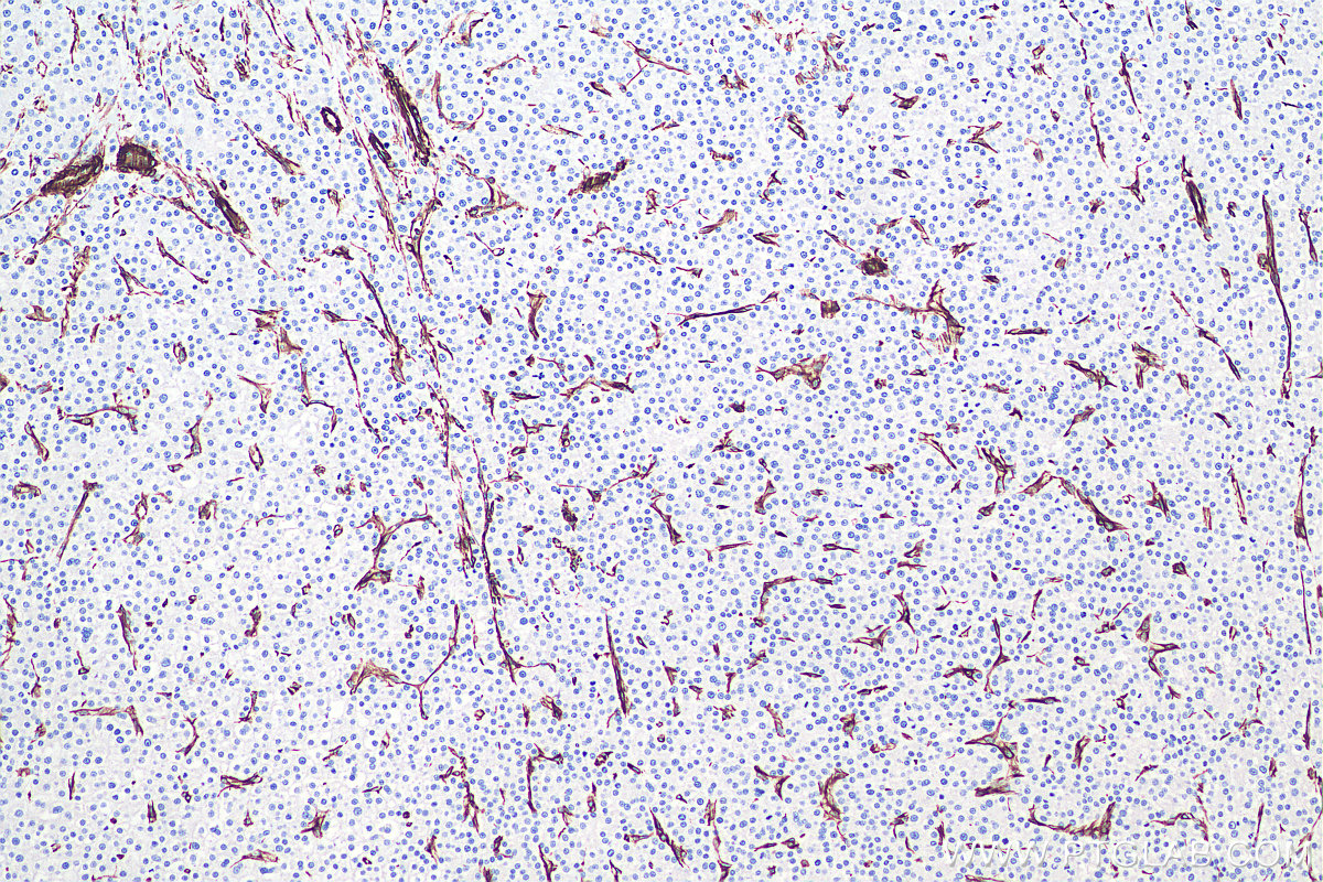 IHC staining of human liver cancer using 60330-1-Ig IHC staining of human liver cancer using 60330-1-Ig