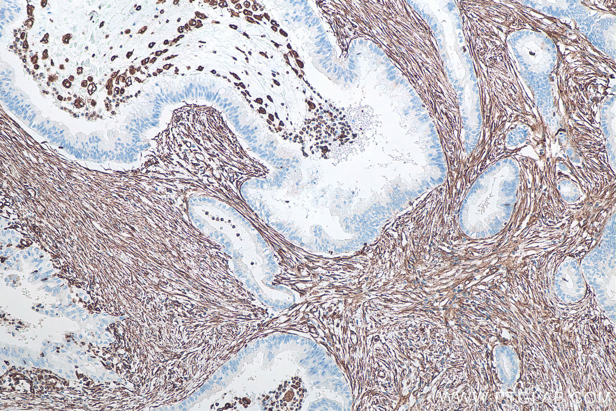 IHC staining of human pancreas cancer using 60330-1-Ig IHC staining of human pancreas cancer using 60330-1-Ig