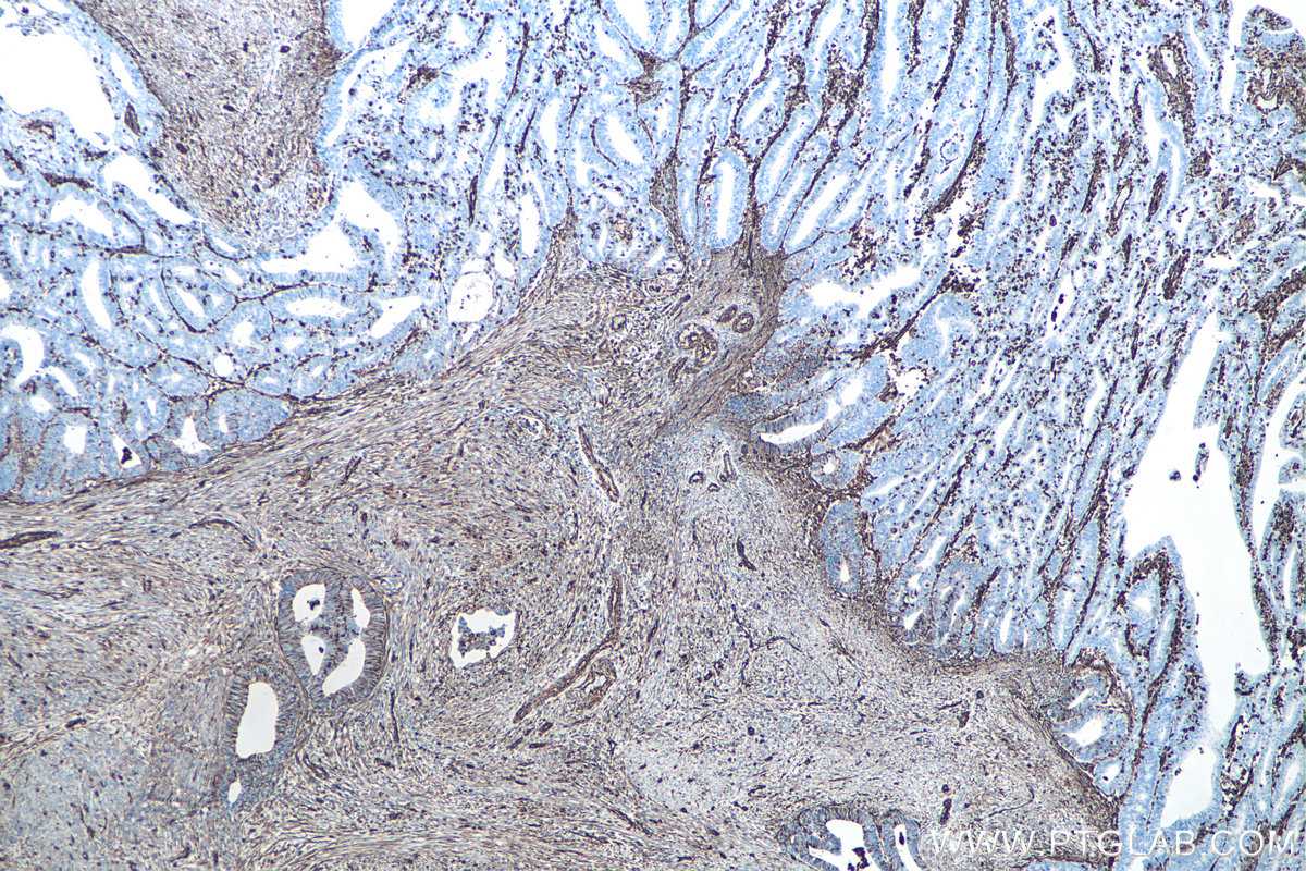 IHC staining of human endometrial cancer using 60330-1-Ig IHC staining of human endometrial cancer using 60330-1-Ig