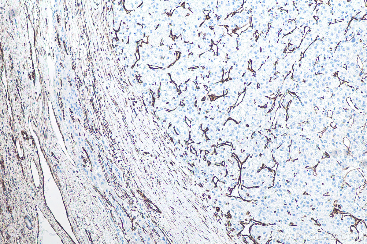 IHC staining of human liver cancer using 60330-1-Ig IHC staining of human liver cancer using 60330-1-Ig