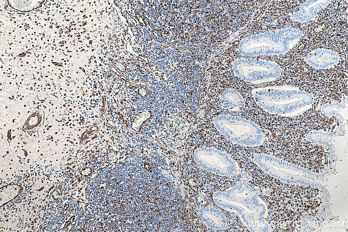 IHC staining of human appendicitis using 60330-1-Ig (same clone as 60330-1-PBS)