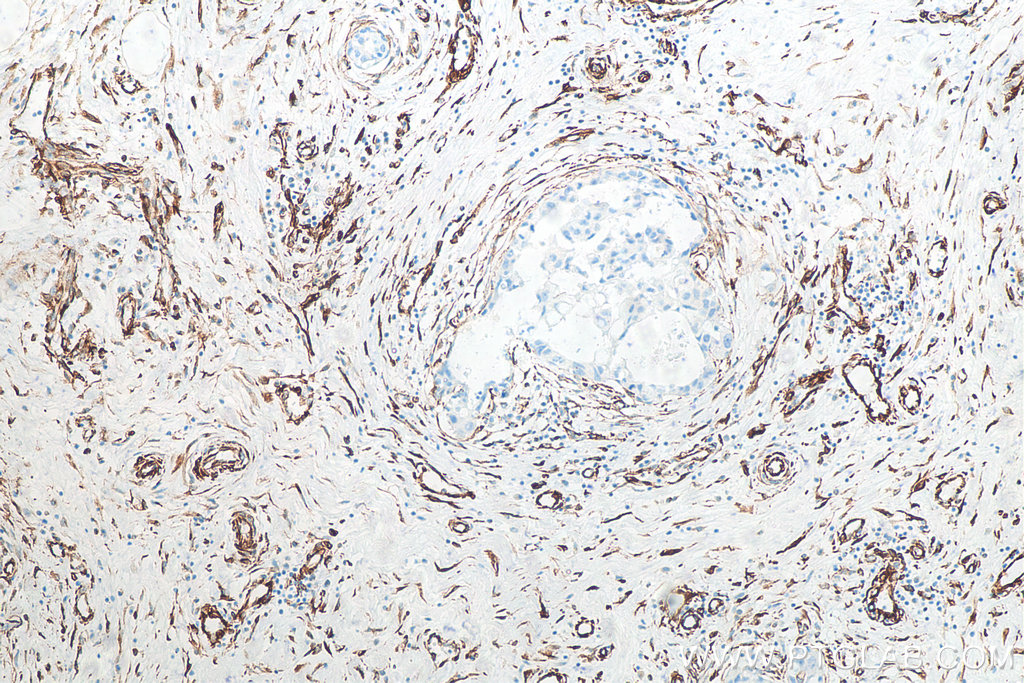 IHC staining of human breast cancer using 80232-1-RR (same clone as 80232-1-PBS)