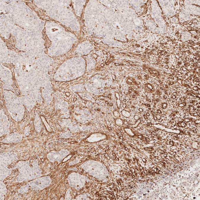 IHC staining of human stomach cancer using 80232-1-RR