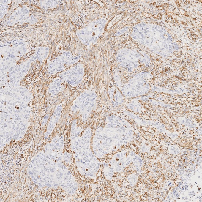 IHC staining of human stomach cancer using 80232-1-RR