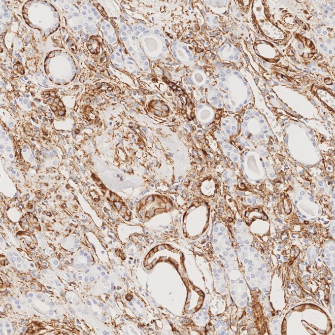 IHC staining of human renal cell carcinoma using 80232-1-RR