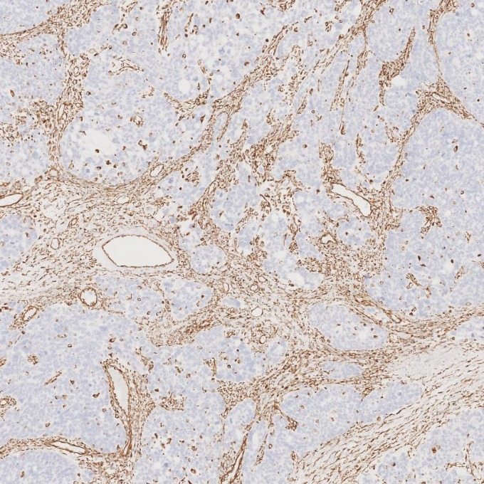 IHC staining of human ovary cancer using 80232-1-RR