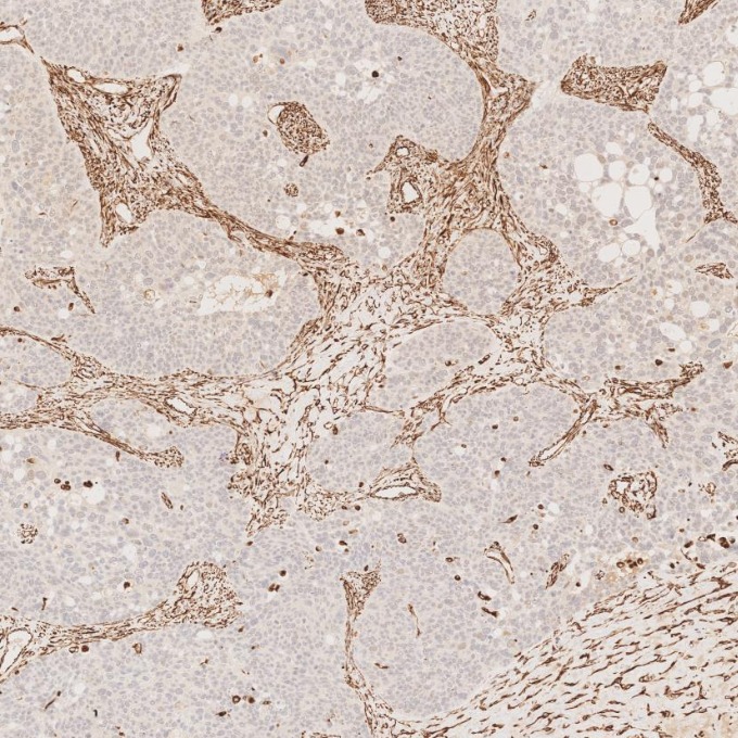 IHC staining of human ovary cancer using 80232-1-RR