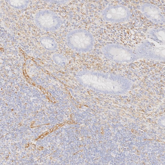IHC staining of human appendicitis using 80232-1-RR