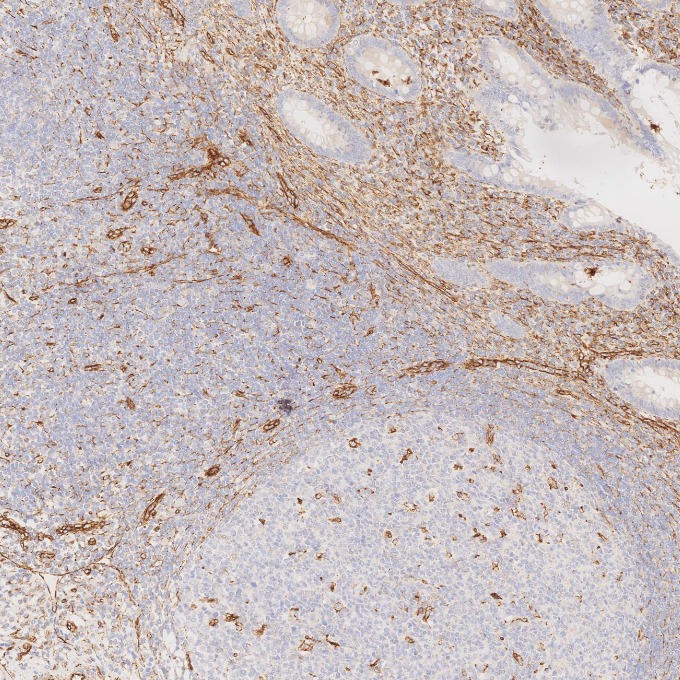 IHC staining of human appendicitis using 80232-1-RR