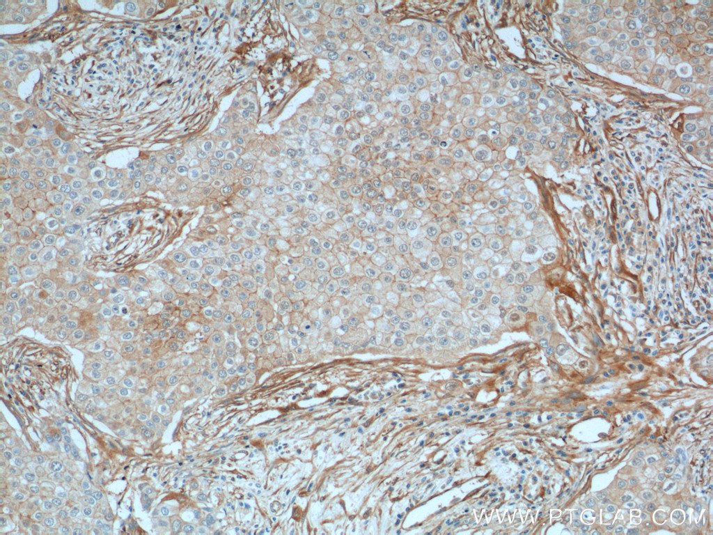 IHC staining of human breast cancer using 66305-1-Ig