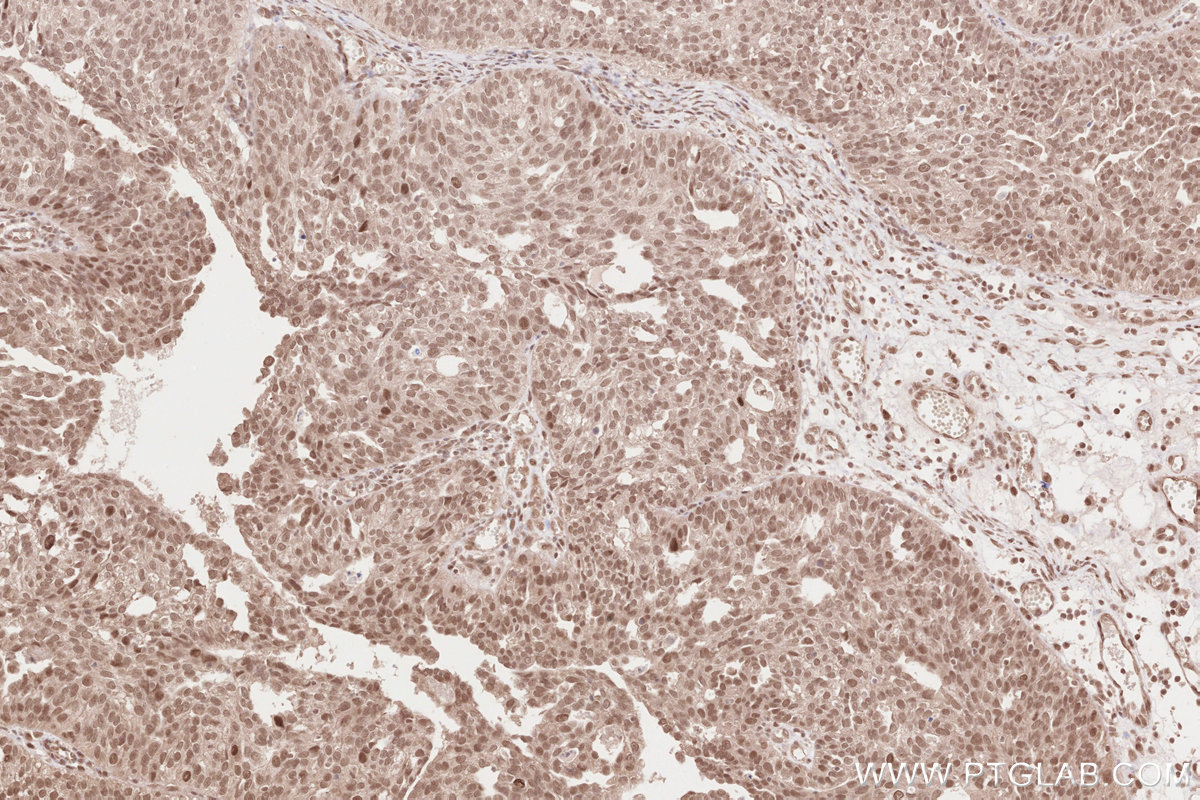 IHC staining of human ovary cancer using 16370-1-AP IHC staining of human ovary cancer using 16370-1-AP