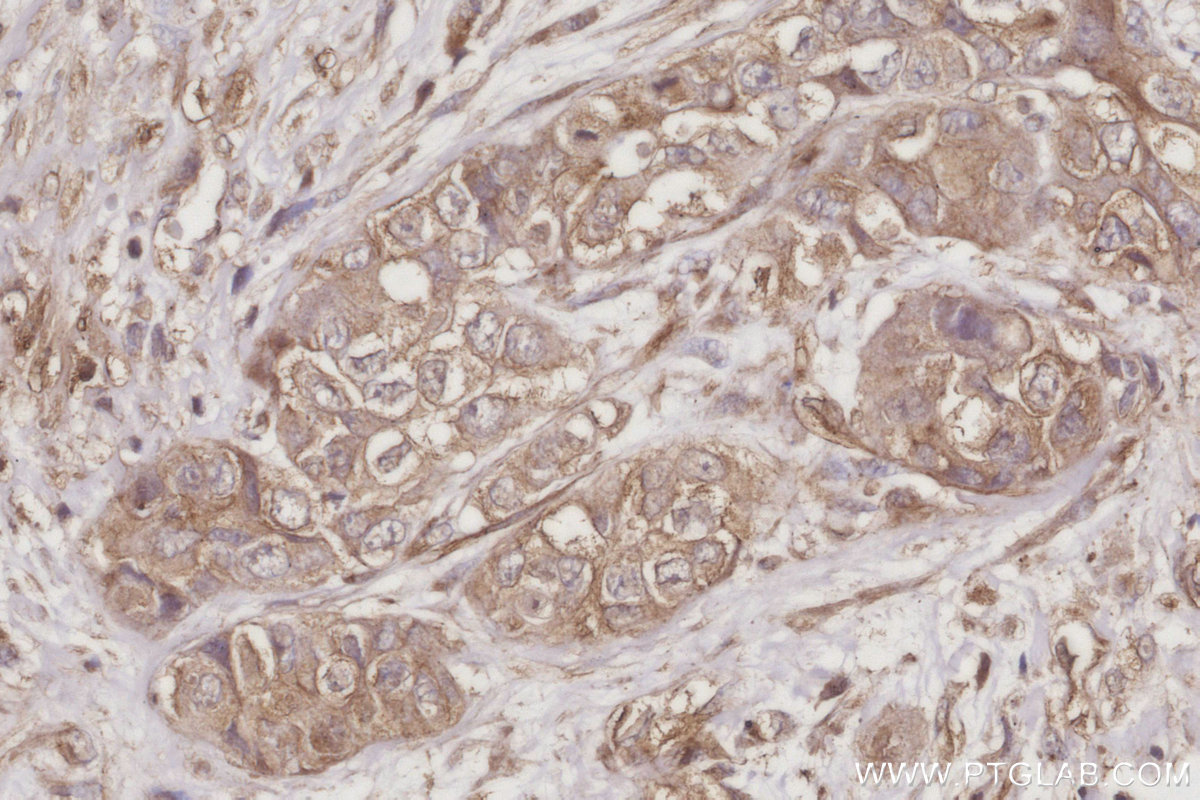 IHC staining of human pancreas cancer using 67620-1-Ig