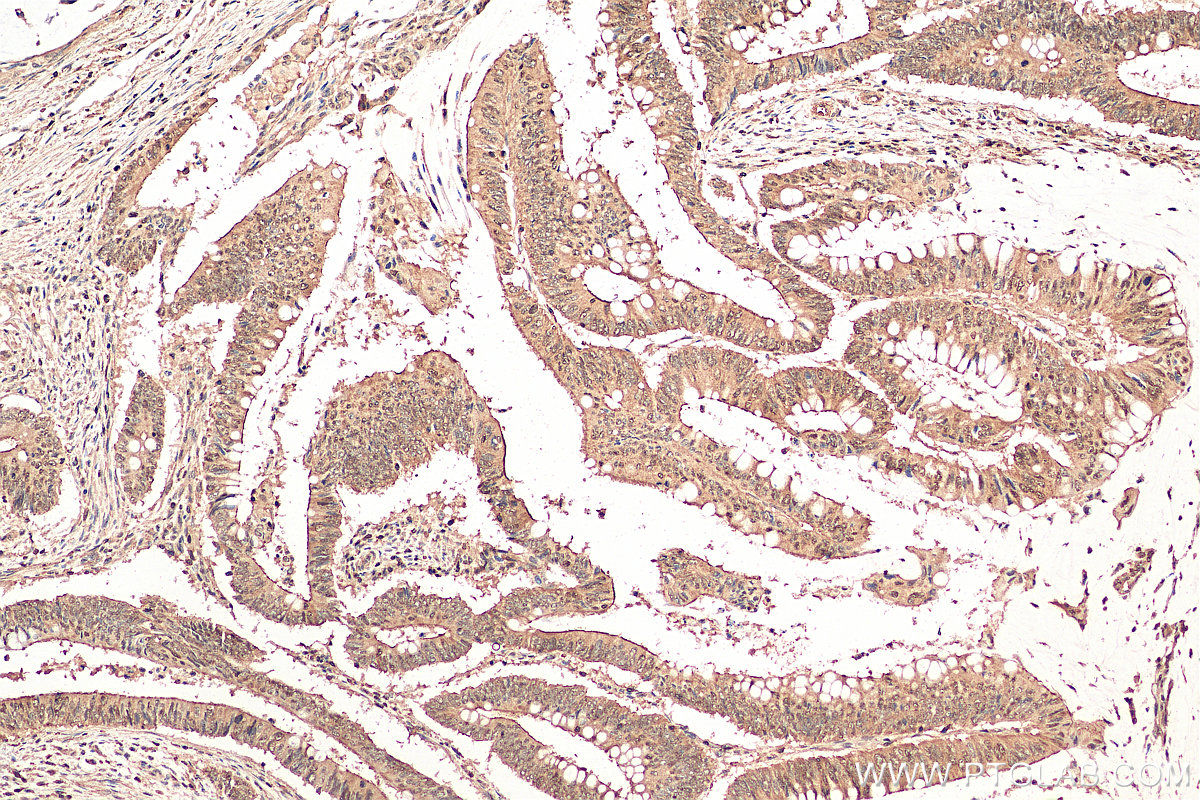 IHC staining of human colon cancer using 28192-1-AP
